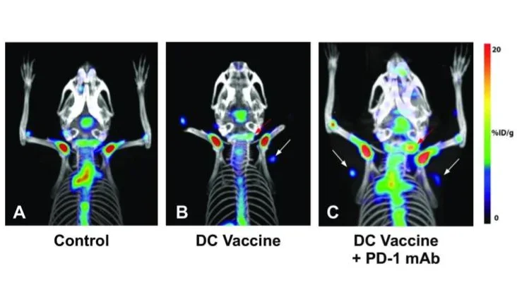 Detection of immune responses after immunotherapy in glioblastoma