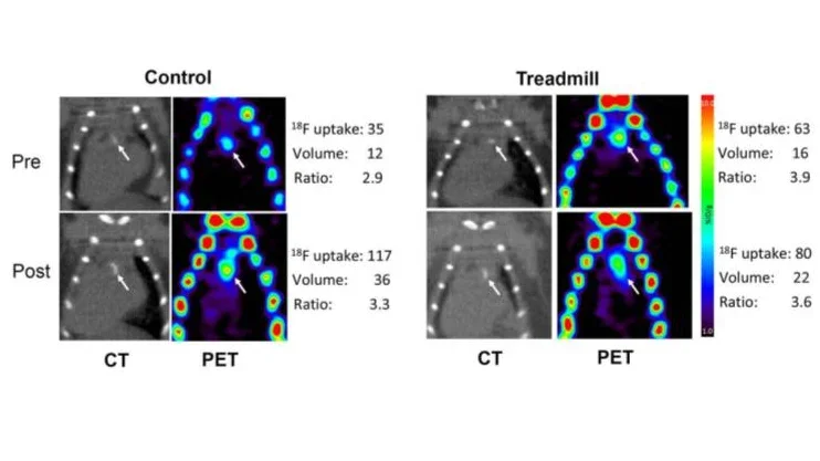 Changes in microarchitecture of atherosclerotic calcification