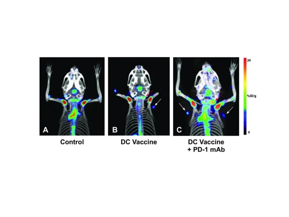 Detection of immune responses after immunotherapy in glioblastoma