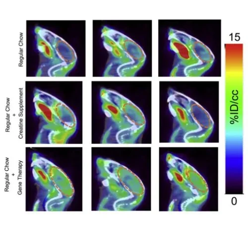 Gene therapy for guanidinoacetate methyltransferase deficiency