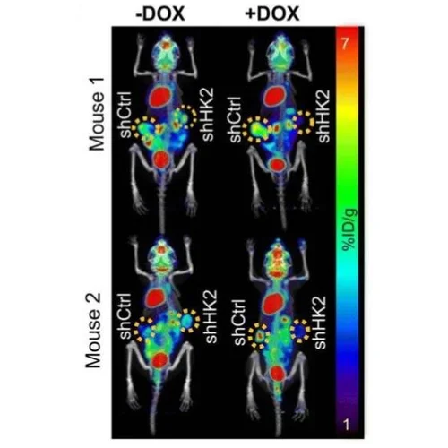 A precision therapeutic strategy for hexokinase 1-null, hexokinase 2-positive cancers